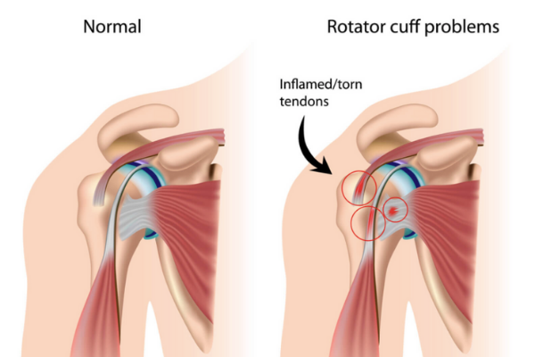 Rotator Cuff Injuries are a Common Baseball Injury